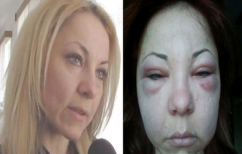 ΝΕΑ ΕΙΔΗΣΕΙΣ (Νόμιζε πως τής έκαναν μπότοξ αλλά ήταν… ενέσεις με δηλητήριο οχιάς! (ΦΩΤΟ))